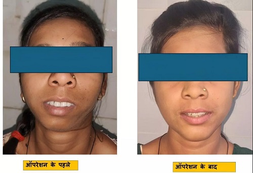 10 साल का दर्द खत्म! बिलासपुर सिम्स में पहली TJR + Orthognathic Surgery सफल, मरीज बोली– अब मैं बिना डर घर से निकल सकती हूँ