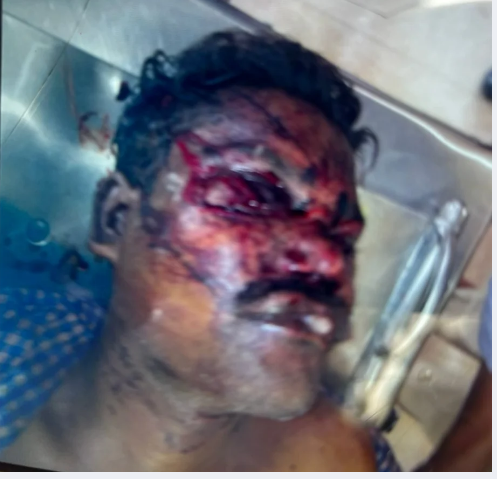 देवादा स्थित मेंटल हॉस्पिटल में मरीज की हत्या, दूसरे मरीज के हमले के बाद मचा हड़कंप..